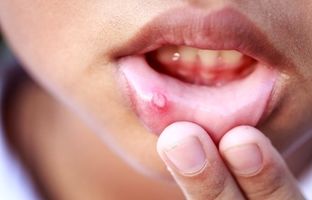 آفت دهان؛ نشانه‌ها، علل و راه‌های درمان آن