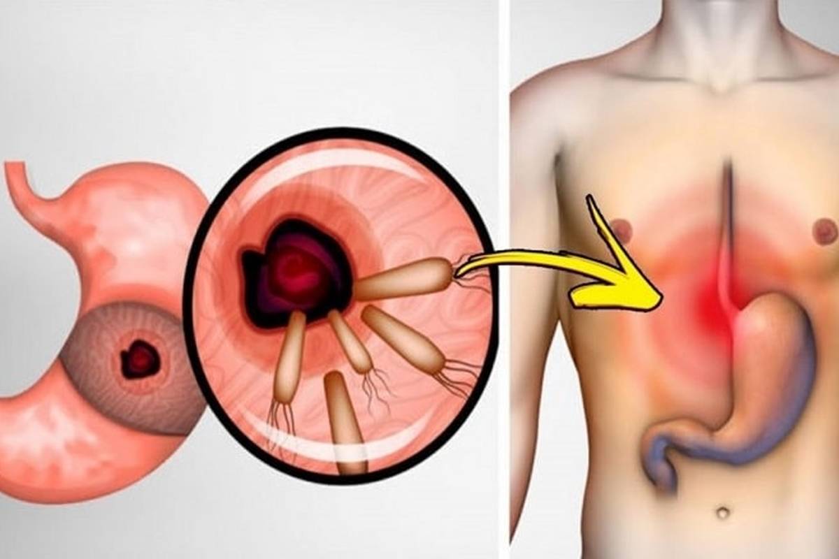  چه عواملی باعث سوزش سر دل می‌شوند؟ 