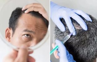 روشی برای فرار از طاسی؛ «بوتاکس جدید» با ریزش مو مقابله می‌کند