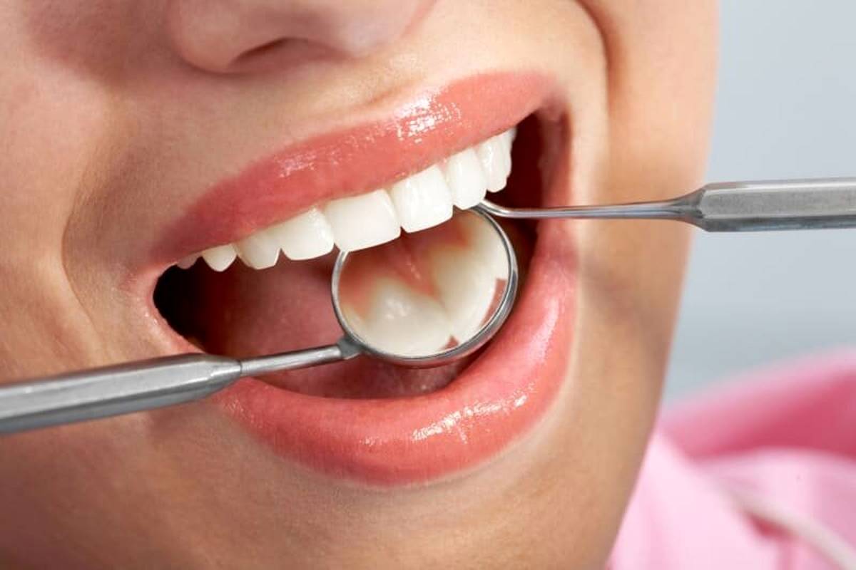 ۷ روش خانگی برای پاک کردن لکه های قهوه ای روی دندان