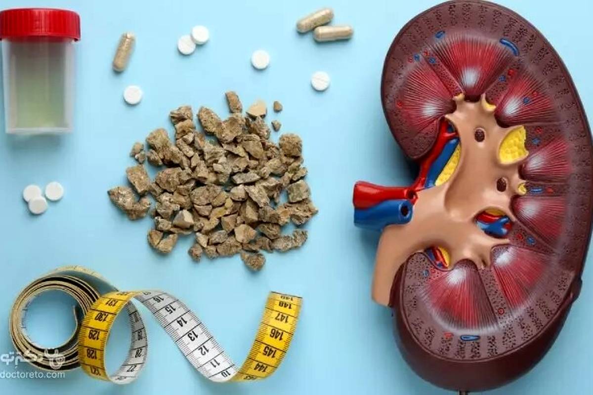 ساده ترین راه برای جلوگیری از سنگ کلیه ؛ این علائم مهم را بشناسید