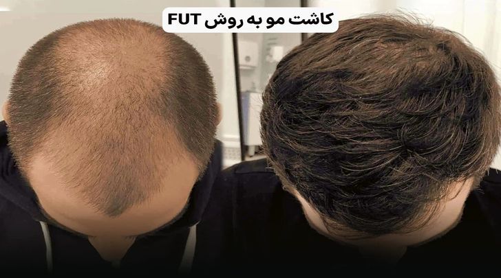 کاشت مو چند روش دارد؟ راهنمای انتخاب بهترین روش برای شما