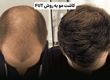 کاشت مو چند روش دارد؟ راهنمای انتخاب بهترین روش برای شما