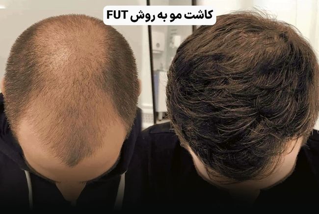 کاشت مو چند روش دارد؟ راهنمای انتخاب بهترین روش برای شما