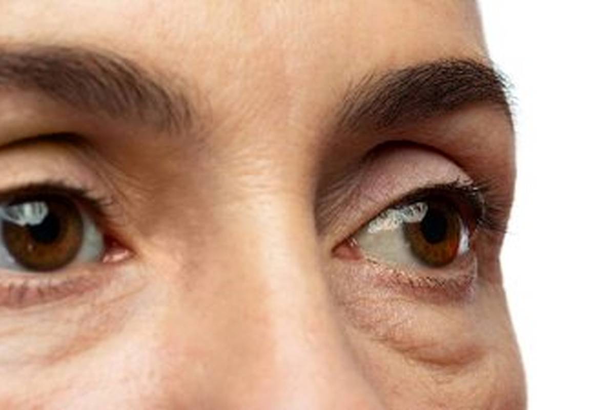 علت ایجاد پف زیر چشم چیست؟/ ۶ روش سریع برای از بین بردن پف زیر چشم