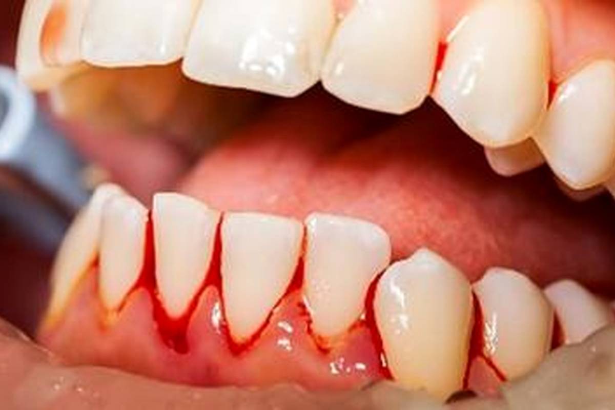 کمبود کدام ویتامین باعث ابتلا به بیماری اسکوروی می شود؟