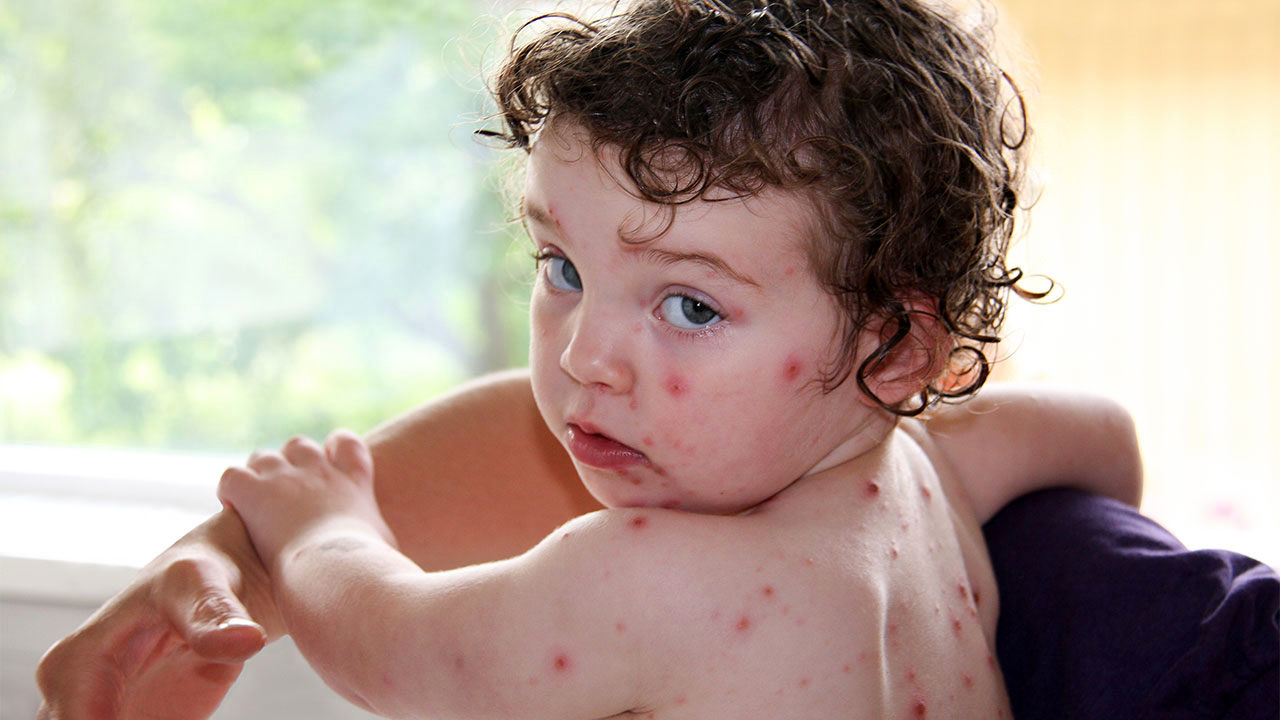 آبله مرغان؛ علل، علائم، پیشگیری و انواع درمان