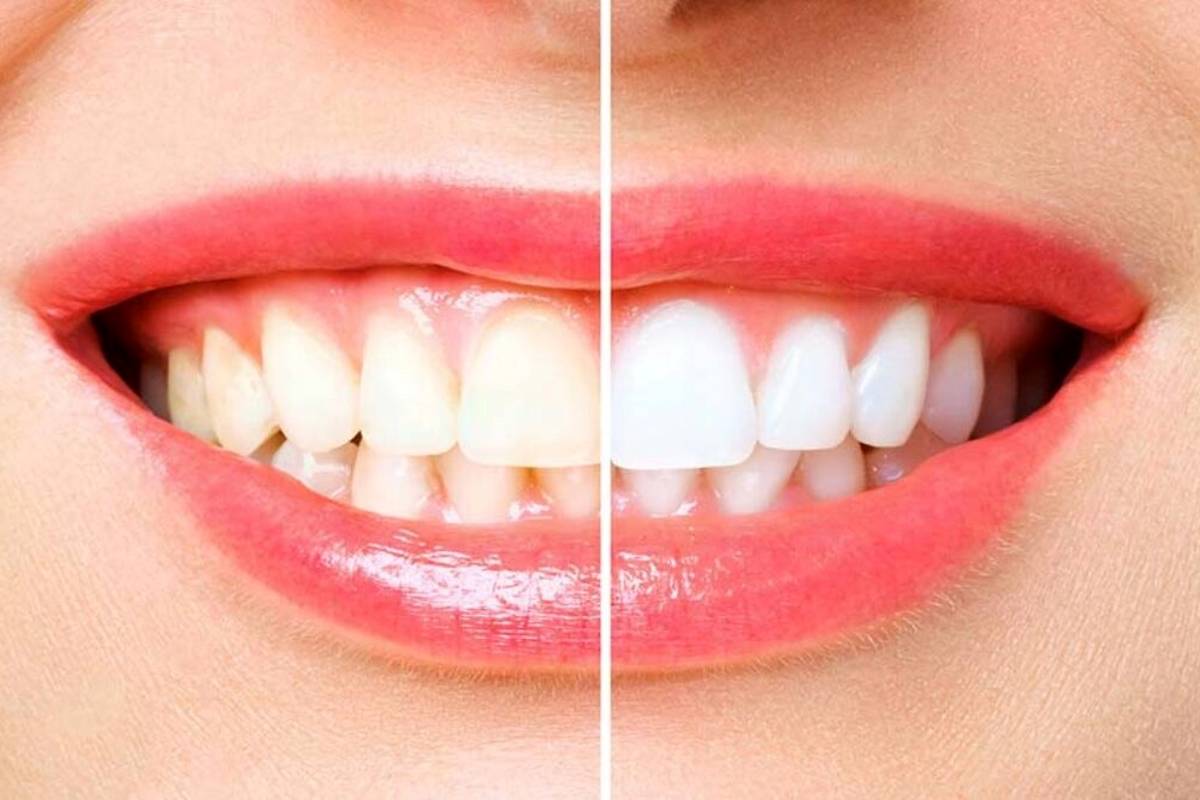چطوری از شر زردی دندان هایمان خلاص شویم؟ از روشهای درمانی تا راهحلهای خانگی
