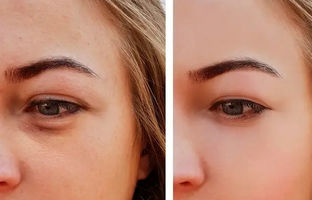 ۸ ترفند ساده و فوری برای از بین بردن پف چشم بعد از گریه