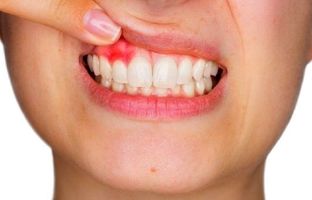 دلایل خونریزی لثه چیست؟ برای درمان آن چه کنیم؟