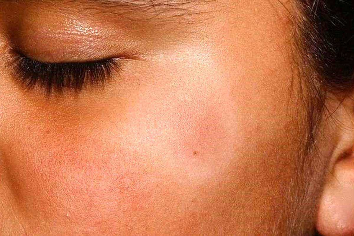 علت لکههای سفید روی پوست کودکان و روشهای درمان آن
