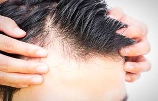 لیست داروهایی که سبب ریزش مو می شوند