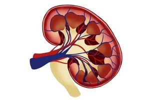 چگونه از سنگ کلیه پیشگیری کنیم؟