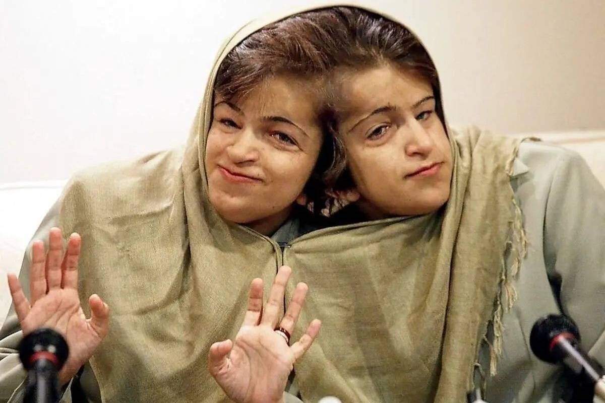 یادی از دوقلوهای بههم چسبیده لاله و لادن + تصویر