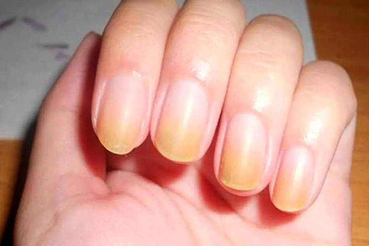 تغییر رنگ ناخن به قهوه ای یا زرد نشانه چیست؟