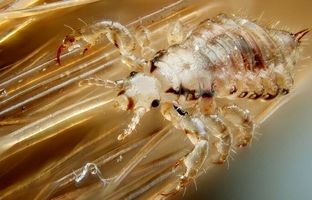 درمان فوری شپش + علائم شپش سر و راهکارهای پیشگیری
