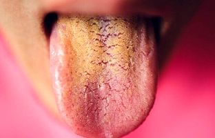 علت زرد بودن زبان/ چطور می‌توان زردی زبان را درمان کرد؟