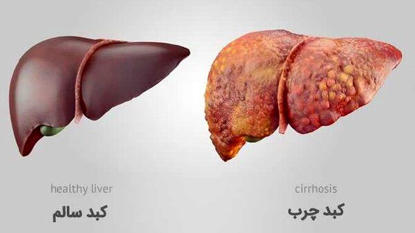 خوراکی‌های مفید و مضر برای کبد را بشناسید
