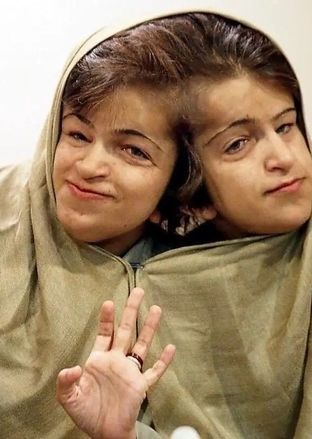  قصه زندگی لاله و لادن; خواهرانی با دو مغز و یک قلب+ عکس مزار 